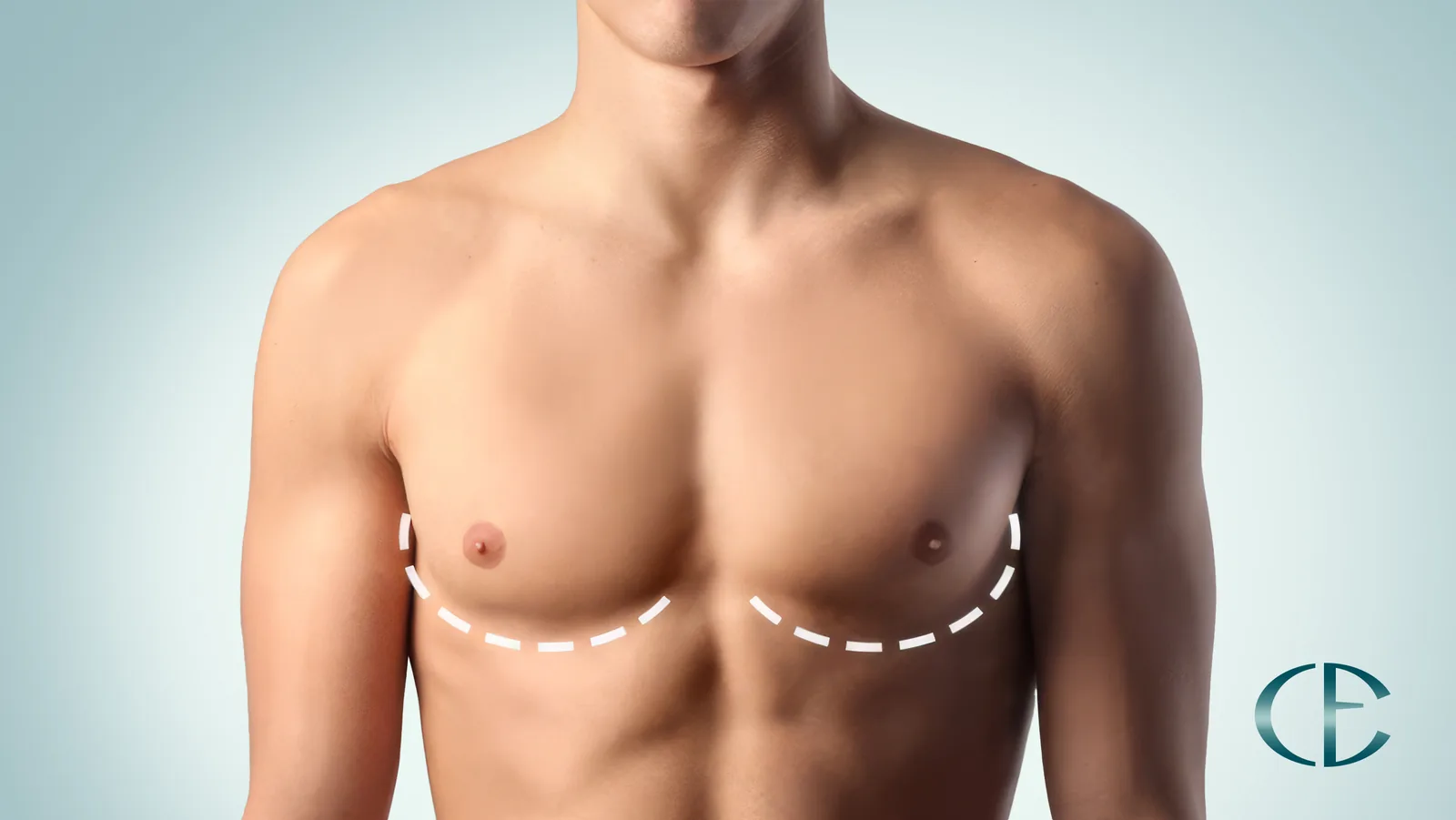 Adana jinekomasti ameliyatı (gynecomastia) — erkek meme küçültme, Prof. Dr. Cengiz Eser