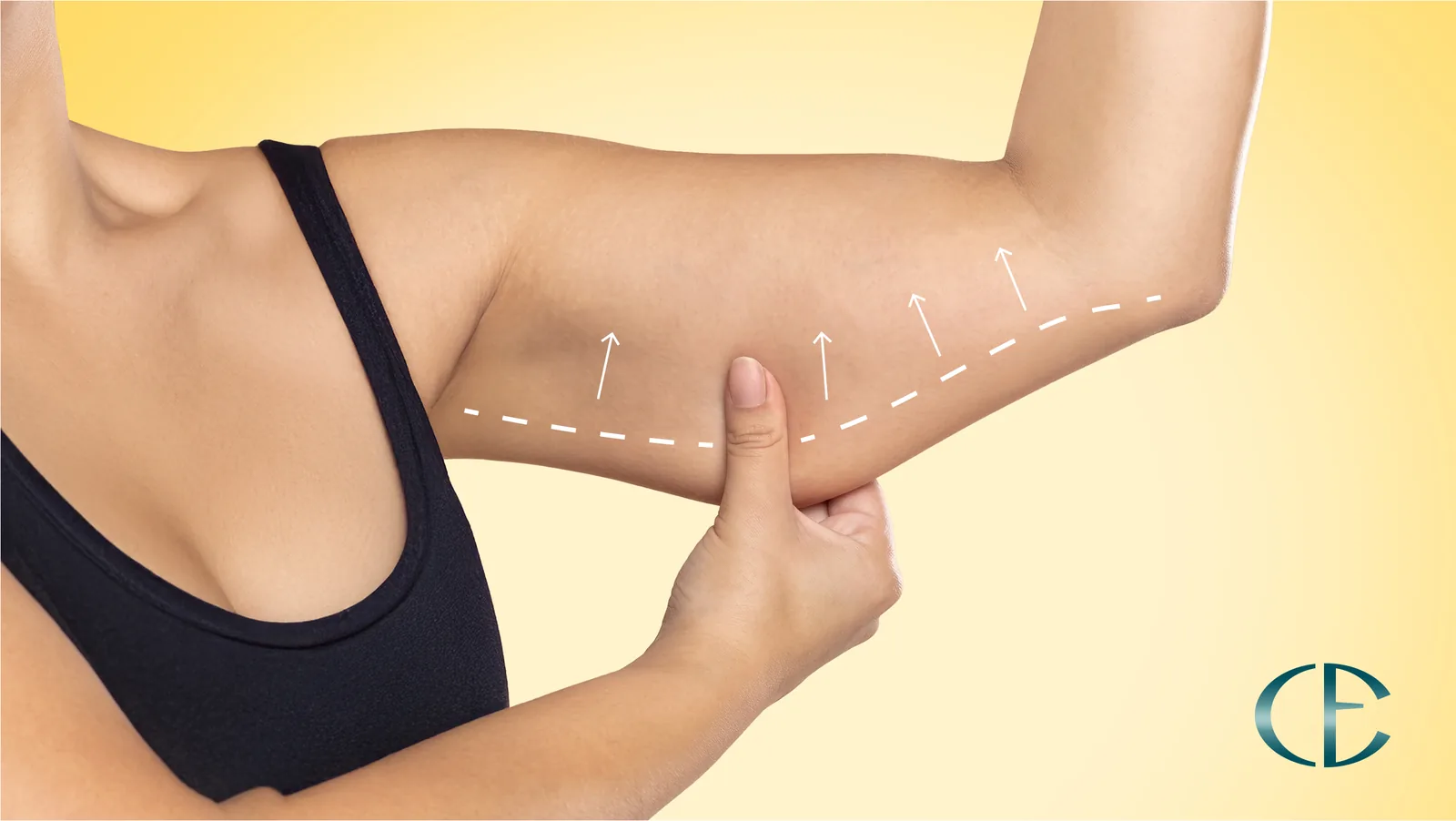 Adana kol germe ameliyatı (arm lift / brachioplasty) — Prof. Dr. Cengiz Eser